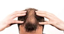 Alopecia: técnicas de tricologia podem oferecer soluções