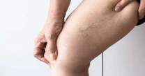 Tratamento de varizes evolui com métodos menos invasivos