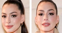 Caso Anne Hathaway: é possível fazer cirurgia plástica sem que ninguém perceba?