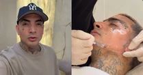 MC Guimê mostra resultado de manutenção da harmonização facial; veja o antes e depois