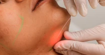 Laser subdérmico surge como alternativa à lipoaspiração