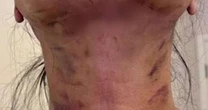 Dentista é denunciada após quatro pacientes terem lesões graves depois de realizar 'lipo de papada'