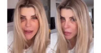 O que aconteceu com Iris Stefanelli? ex-BBB surge com olho roxo, gera preocupação e esclarece causa do hematoma