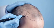 Tecnologia visa mais naturalidade em transplante capilares