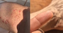 Influenciador viraliza ao ser modido por sucuri e cobra fincar dente em sua pele