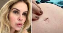 Umbigo 'deformado'? Entenda a condição que afeta Bárbara Evans