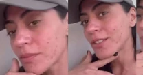 Clarice de 'Garota do Momento', Carol Castro tem doença crônica; médica alerta sobre diagnóstico e cuidados: 'É recomendável evitar...'