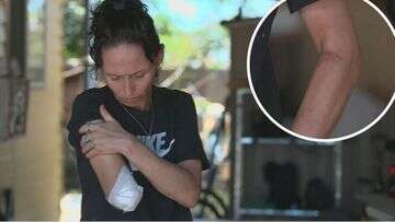 Queensland mum says she doesn't blame her dog after he ripped her arm off