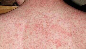 Health warning after measles case identified in Perth