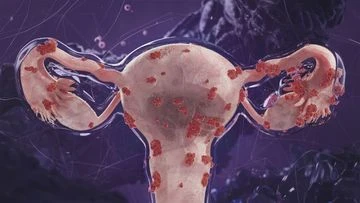 'It never stops': New drug to treat endometriosis after decade of pain