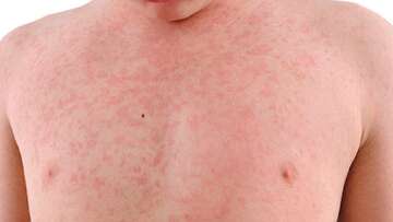 Measles outbreak sparks health warning across Victoria