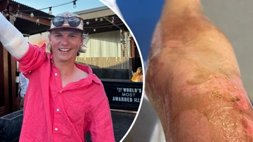 'I freaked out': Uni student's arm 'torched' after phone charger exploded