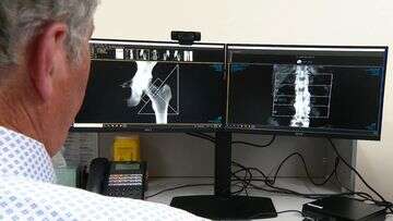 Thousands more Aussies to get access to osteoporosis treatment