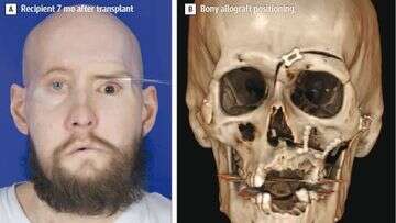 Doctors hail world-first eye transplant after landmark result