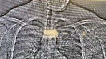 X-ray shows diamond earrings swallowed by theft suspect during arrest