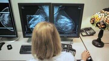 Incurable breast cancer numbers are almost three times higher than previously estimated