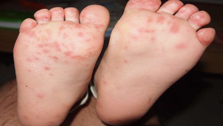 KZN hand, foot and mouth disease cases rise to 117