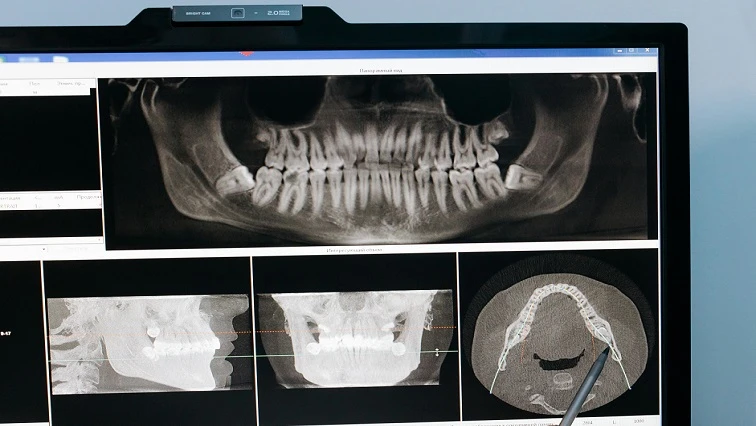 Accused 3 in Meyiwa trial didn’t have gold tooth: Dental report