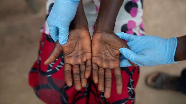 Mpox cases in SA rise to 16