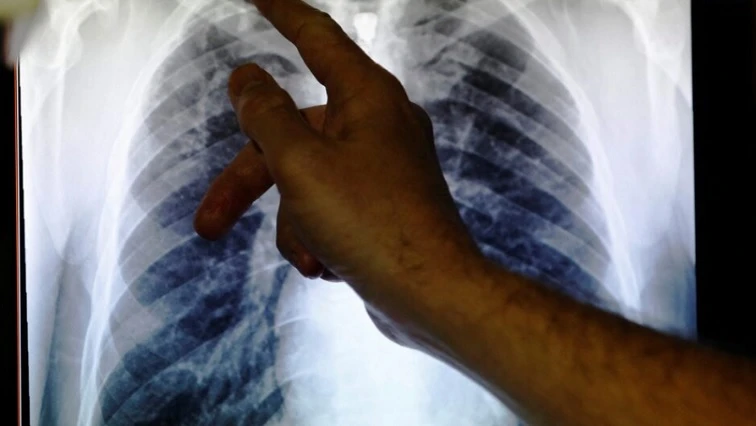 FS ramps up TB campaign, targets 22,000 defaulters and mine workers