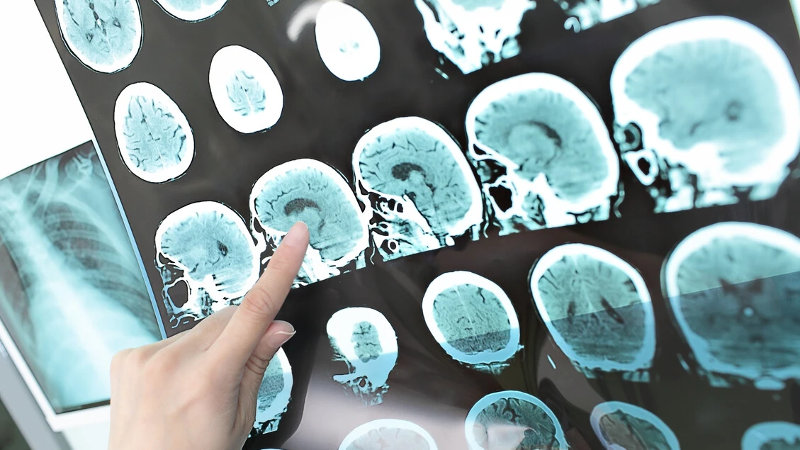 Dall'Iss linee guida per diagnosi e cura di due effetti dell'ictus