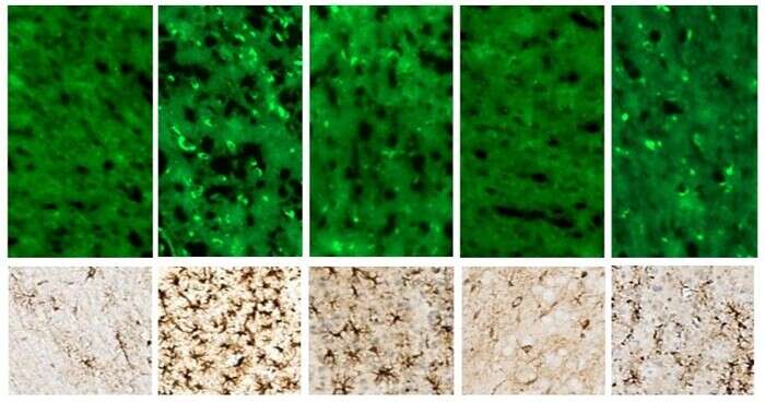 Pinzette molecolari contro una rara malattia genetica infantile