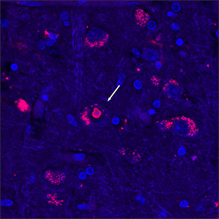 Scoperta dopo 25 anni la causa di una rara malattia neurologica