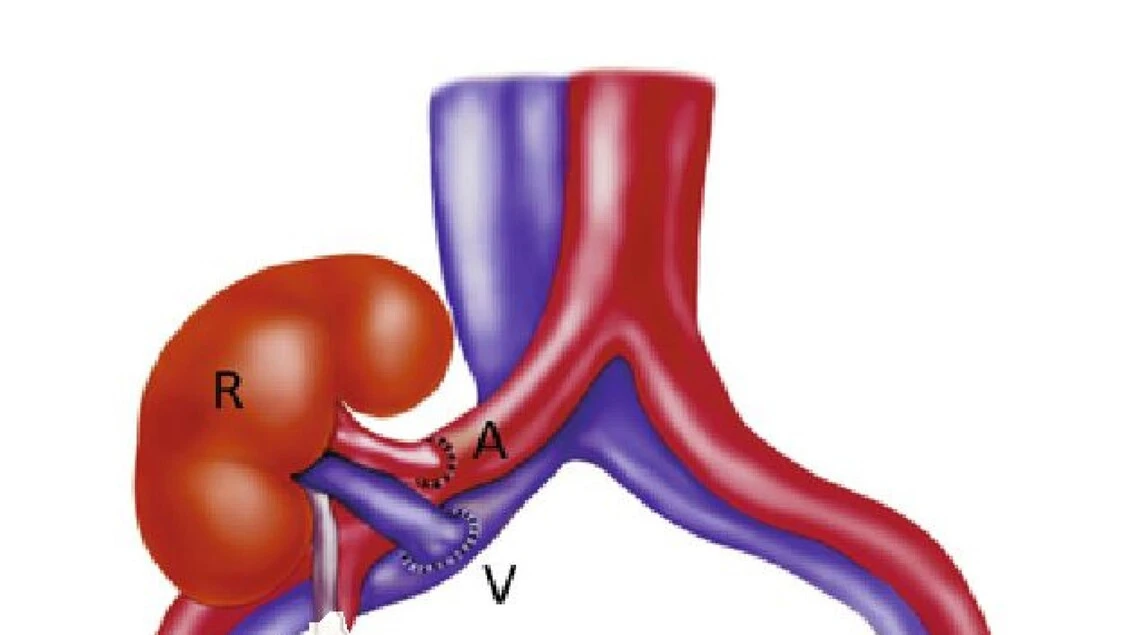 Tumori urologici, ogni anno 87mila nuovi casi in Italia