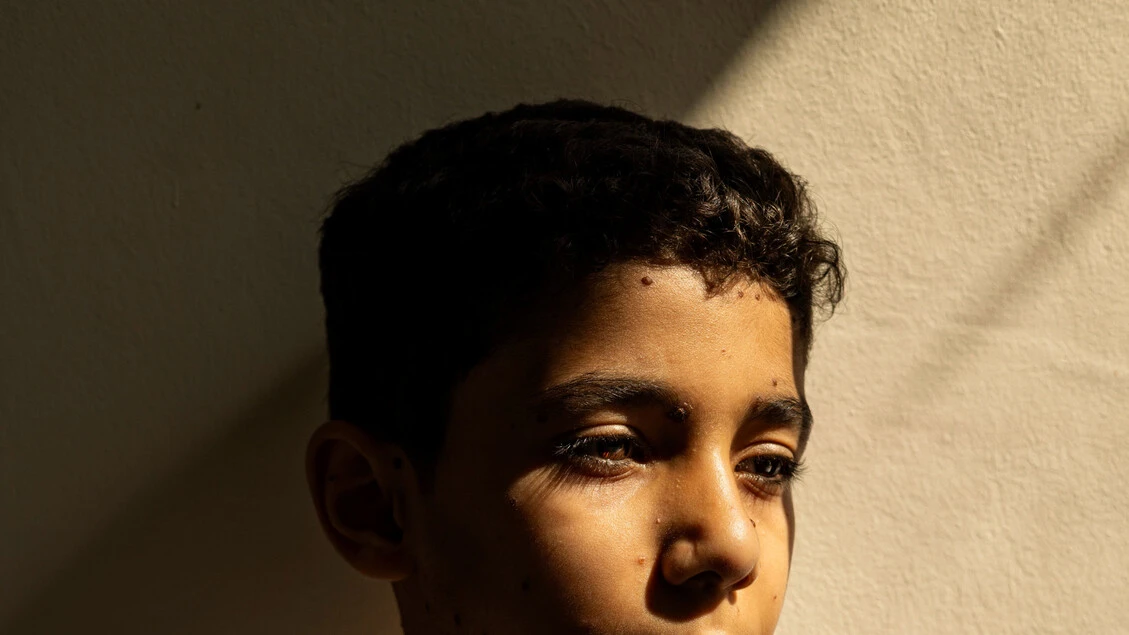 World Press Photo, il bambino amputato a Gaza è foto dell'anno