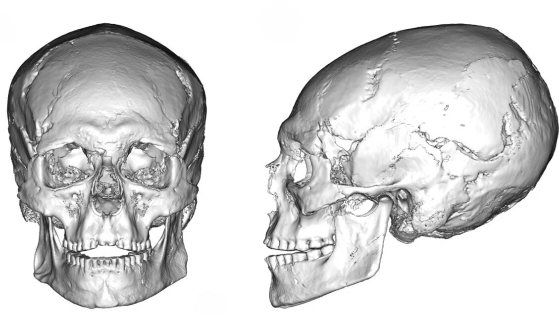Cranio di 12.000 anni svela pratica intenzionale di deformazione