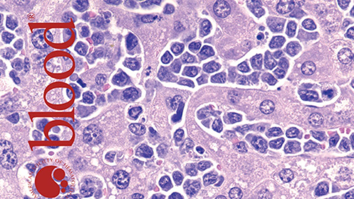 Leucemia pediatrica acuta, studio individua possibile terapia