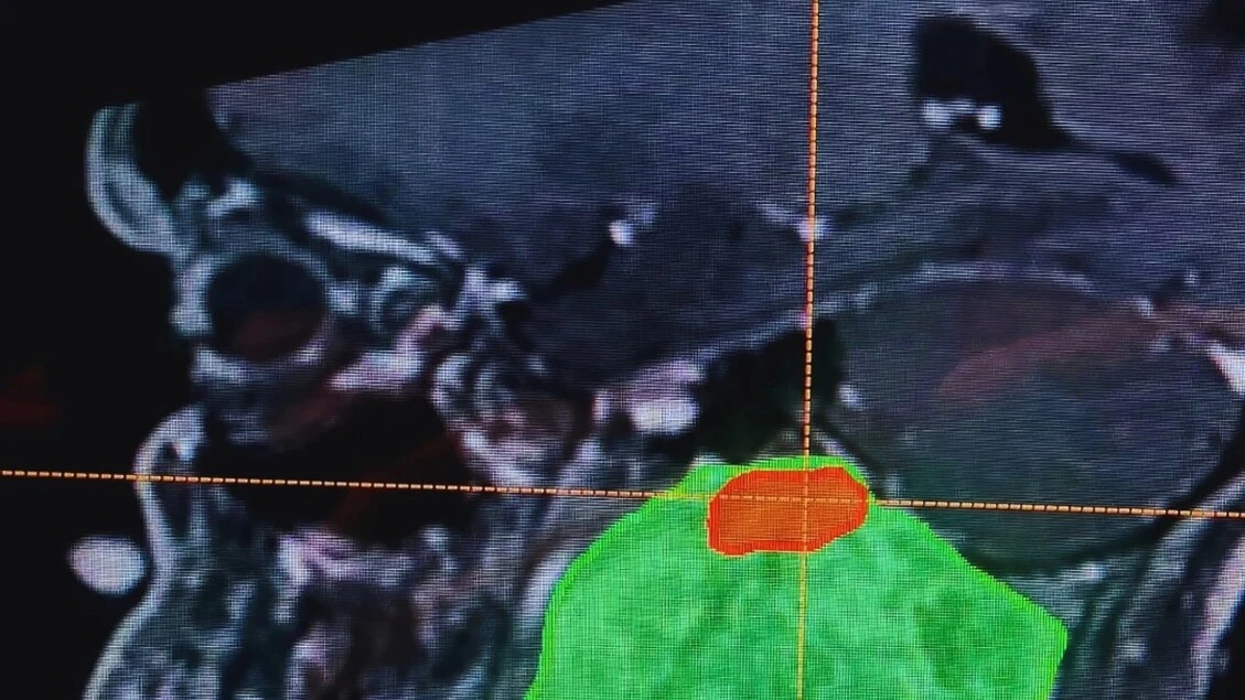 Asportato tumore di 228 cmü dal basicranio a una paziente 54enne
