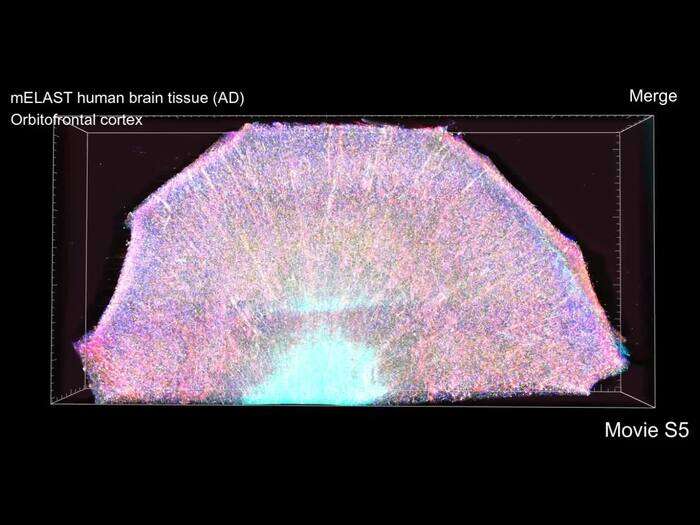 Zoom su un cervello colpito dall'Alzheimer (fonte: Chung Lab/MIT Picower Institute)