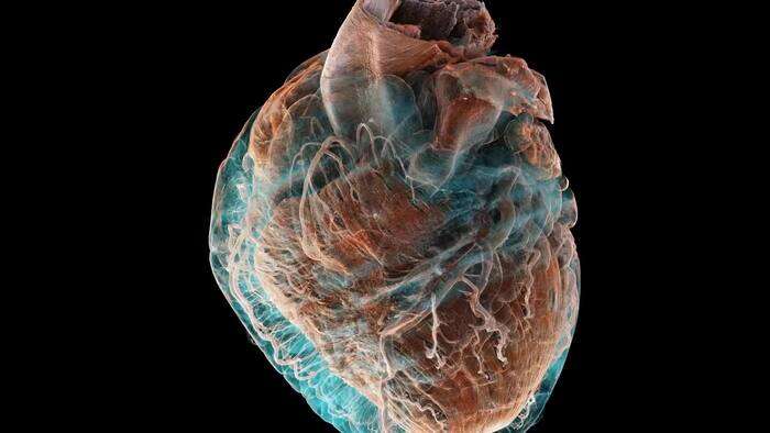 Un cuore sano a confronto con uno malato, in un dettaglio mai visto (fonte: Brunet et al., Radiology)