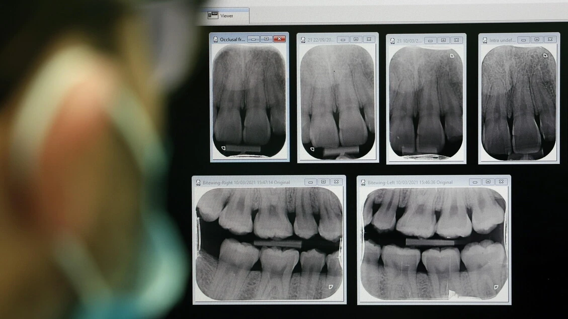 Estrazioni controllate opzione per denti disallineati