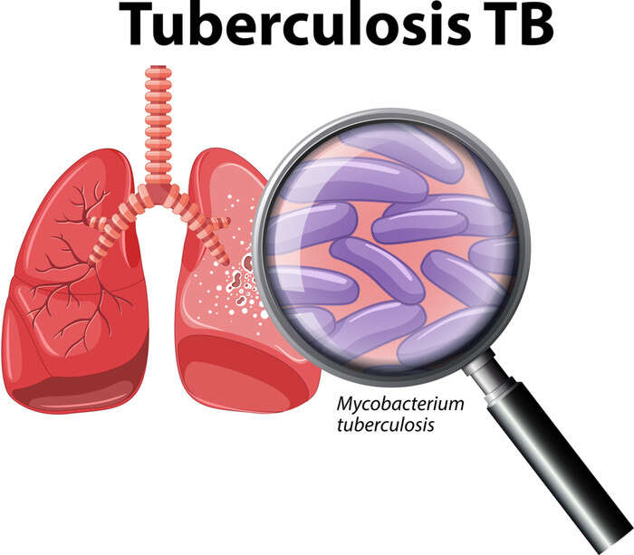 'La Tbc principale minaccia infettiva', oltre 8 milioni di casi nel 2023