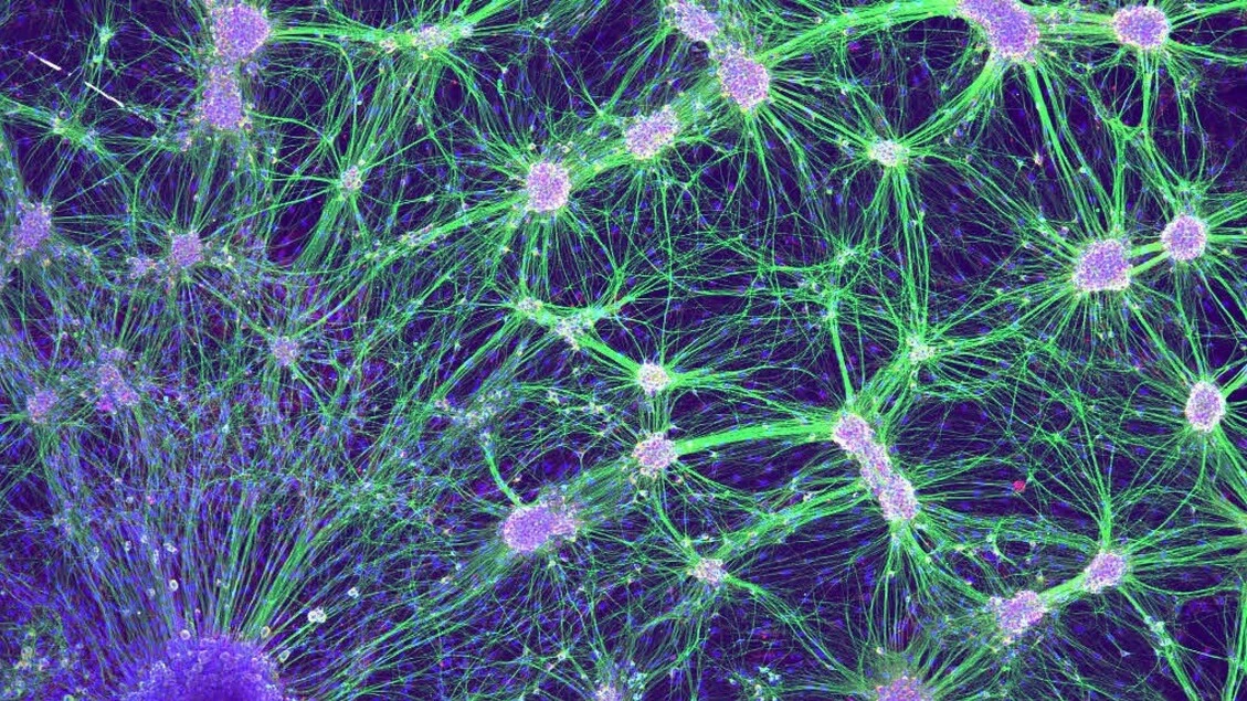 Depressione e Alzheimer, con terapia magnetica risultati migliori rispetto a farmaci