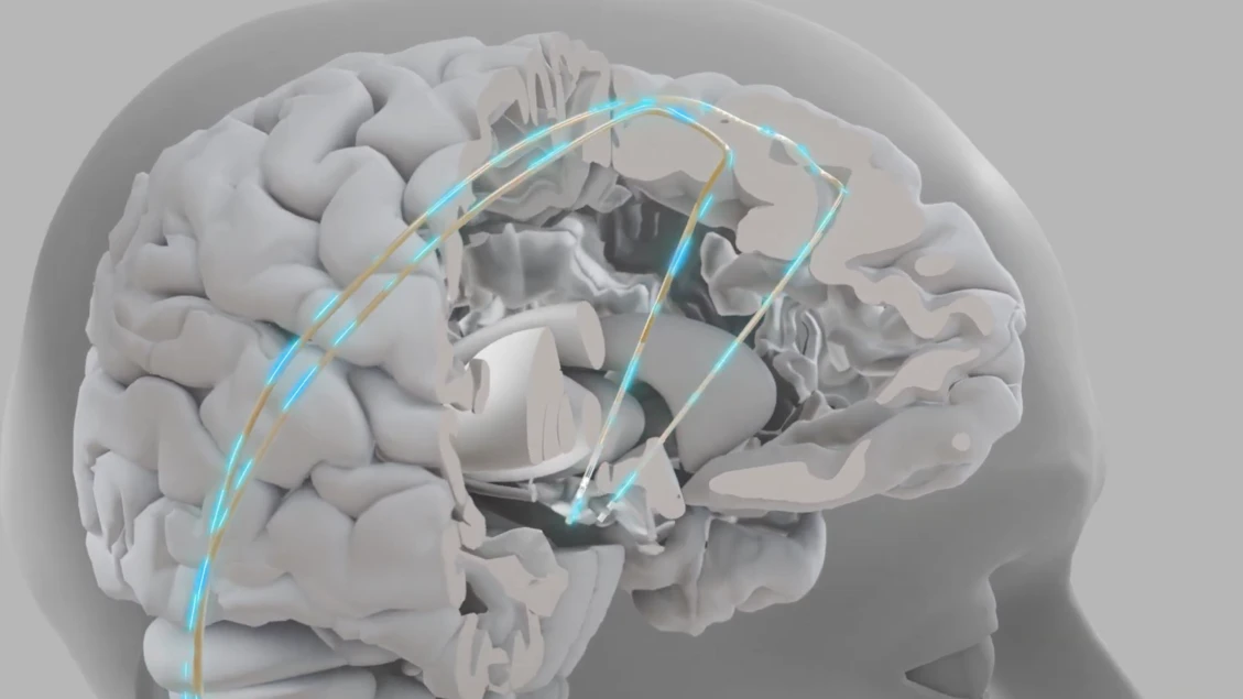 Chip impiantabili più vicini, aiutano a parlare e a camminare VIDEO