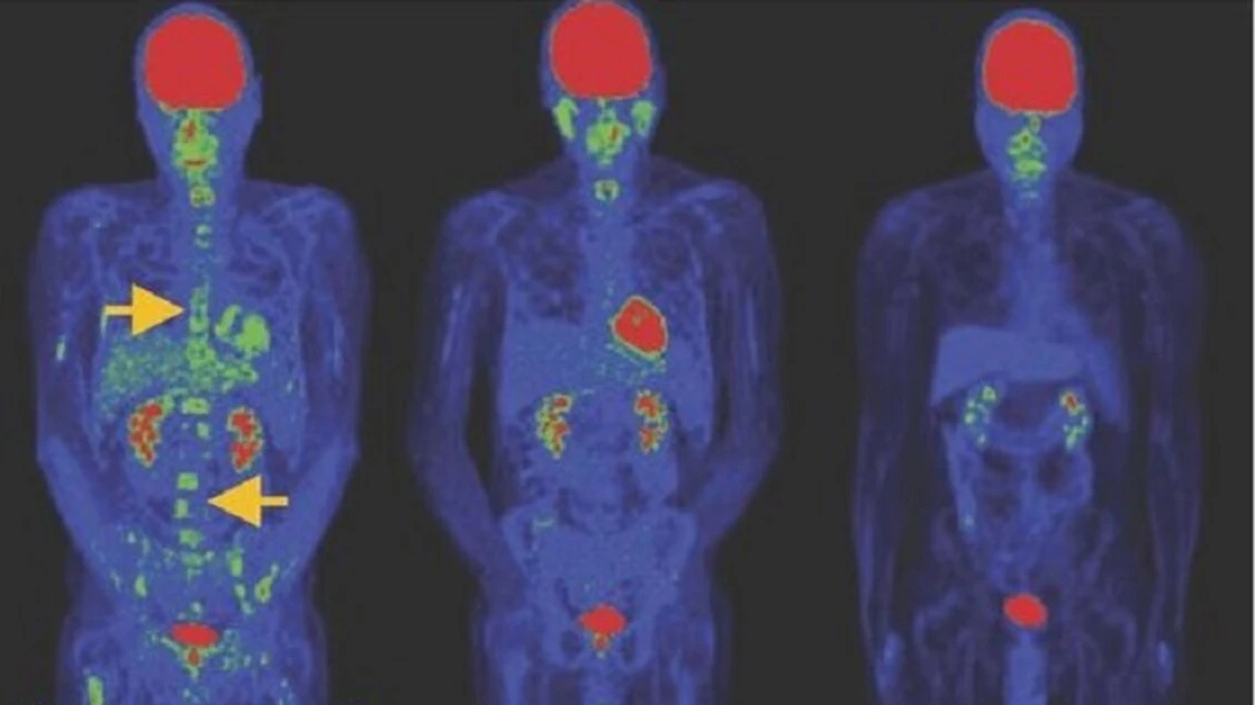Tumori del sangue, nuova terapia Car T dà remissione a basse dosi