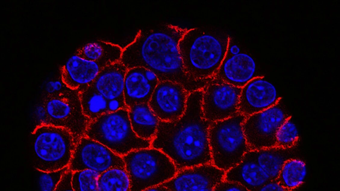 Tumore al pancreas, trovata la proteina che lo rende resistente ai farmaci