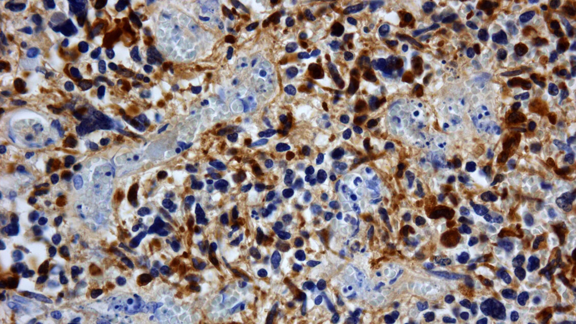 Allo studio un vaccino personalizzato contro il glioblastoma