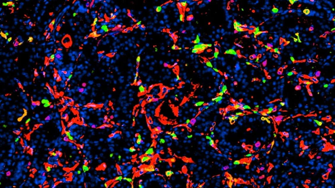 Nanoparticelle efficaci contro il tumore della prostata, uccidono le cellule