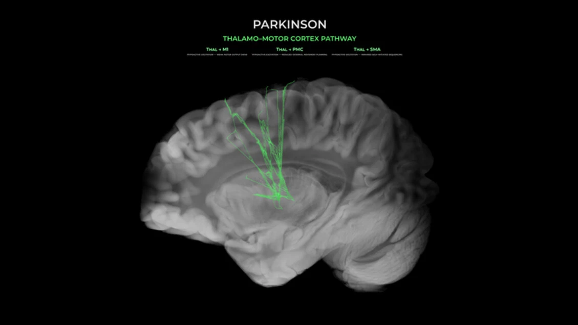 Parkinson, ultrasuoni in un caschetto cancellano i tremori in modo non invasivo
