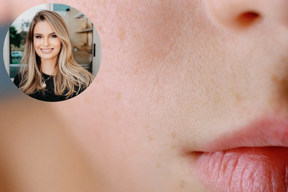 Dermatologista esclarece dúvidas sobre tratamentos de manchas na pele