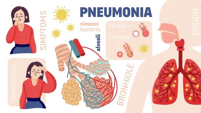 Bronkopneumonia dan Pneumonia, Simak Perbedaan dan Persamaannya di Sini