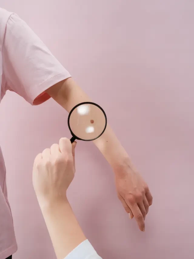 Tahi Lalat di Tangan hingga Kaki, Benarkah Bisa Ungkap Sifat Aslimu?