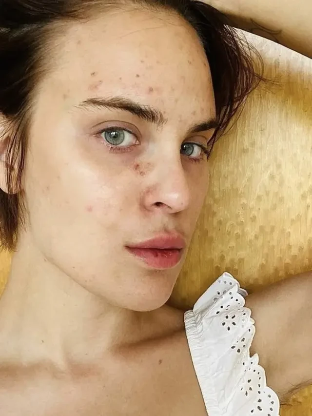 Talullah Willis Anak Demi Moore Ungkap Masalah Kulit Unik yang Sempat Dialaminya, Kini Mem...