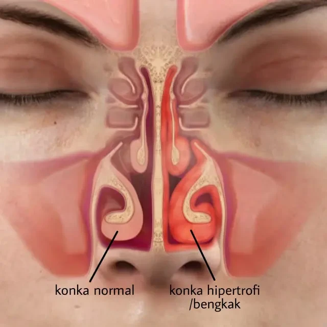 Berbahaya, Jangan Sepelekan Bahaya Konka Hidung Membengkak