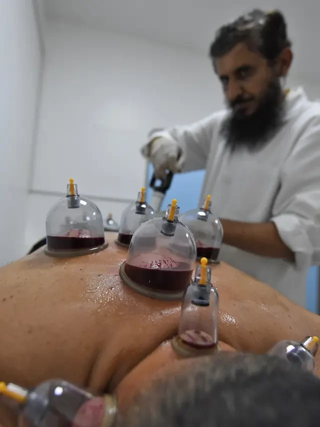 Punya Manfaat, Dokter Ungkap Cara Jadikan Bekam sebagai Layanan Kesehatan Formal