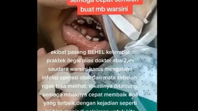 TKI di Taiwan Alami Infeksi Otak dan Mata Buta Sebelah Usai Pasang Behel